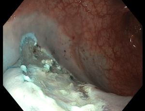 Colonoscopic submucosal dissection can remove superficial tumours from large intestine without resorting to surgery