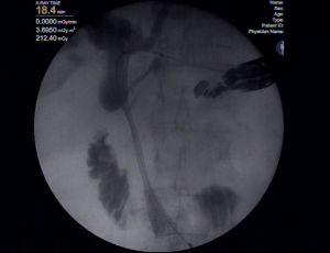Bile duct obstruction can be treated in most difficult situations by use of endoscopic ultrasonography