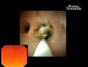 Miniature endoscopes can reach directly within bile duct to remove stones